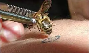 Venin d'abeille piqûre apipuncture